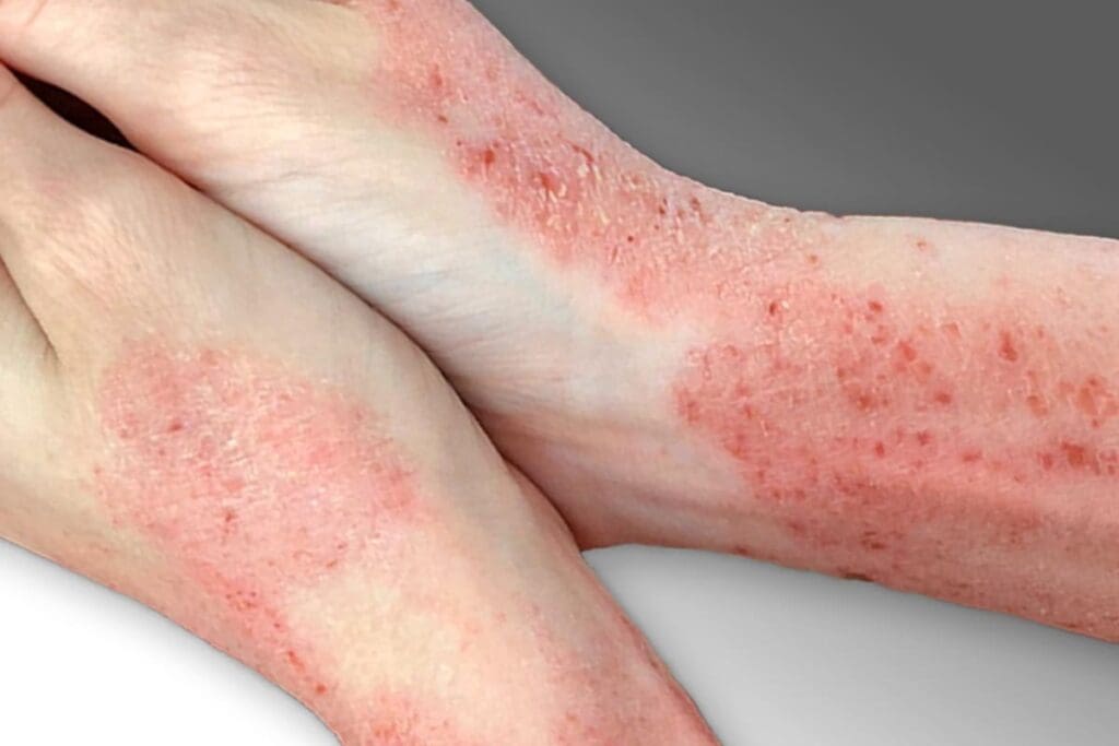 Eczema Skin Condition -Whipped Tallow Balm May Provide Some Relief for Your Skin